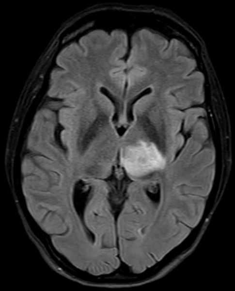 МРТ головного мозга в аксиальной плоскости