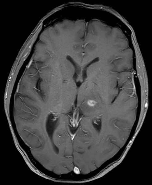 МРТ головного мозга в аксиальной плоскости с контрастом