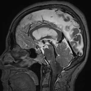 МРТ головного мозга c ликвородинамикой