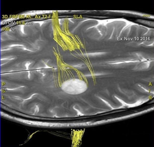 нервные пучки на МРТ головного мозга