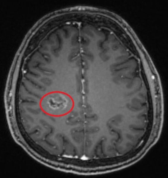 МРТ головного мозга с контрастированием