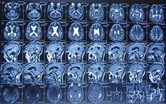Сколько длится томография головного мозга