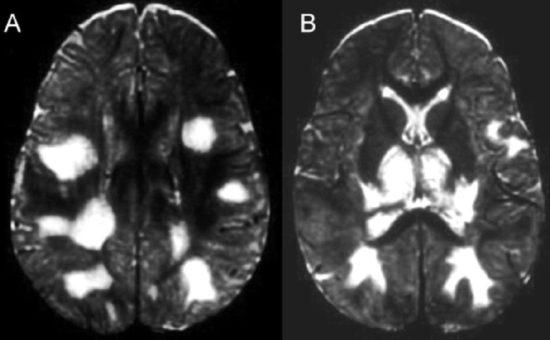 Энцефалит головного мозга на МРТ