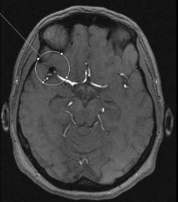 МРТ сосудов головного мозга. На МР-томограммев области М2 сегмента правой средней мозговой артерии отмечается неправильной формы артефакт от микроспиралей