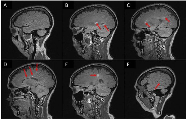 Признаки рассеянного склероза на МРТ головного мозга