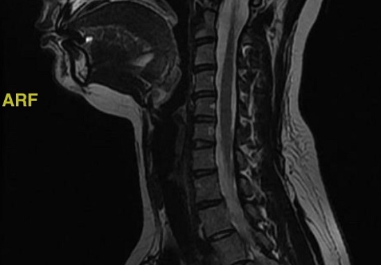 Как выглядят нервы на снимке МРТ
