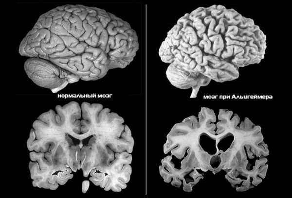 Болезнь Альцгеймера на МРТ