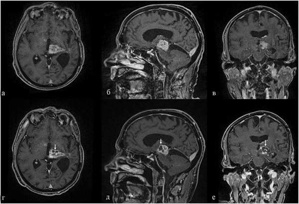Какие бывают виды МРТ головы
