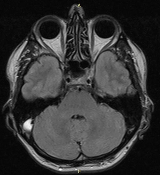МРТ головного мозга. Тромбоз правого сигмовидного синуса.