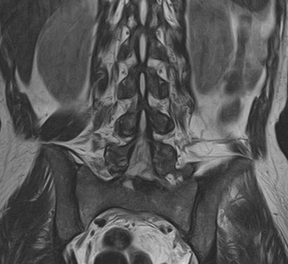 МР-картина дегенеративных изменений синовиальной части крестцово-подвздошных суставов