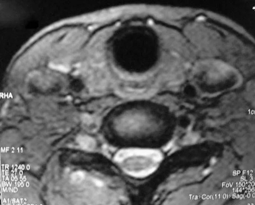 МРТ щитовидной железы, что показывает