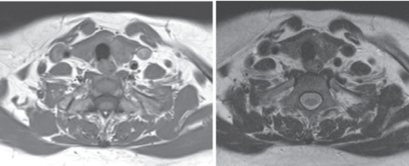 МРТ щитовидной железы с контрастом
